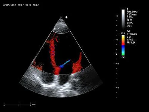 тканевой допплер (TDI)